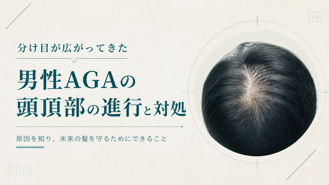 分け目が広がってきた｜男性AGAの頭頂部進行と対処